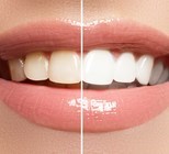 תוך שעה בלבד: הטכנולוגיה החדשה שמאפשרת הלבנת שיניים בקלות ובמהירות-תמונה